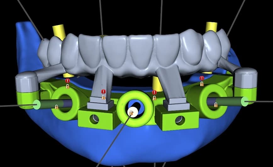 Full-arch guide with multi-unit abutment positions and prosthetic teeth reference.