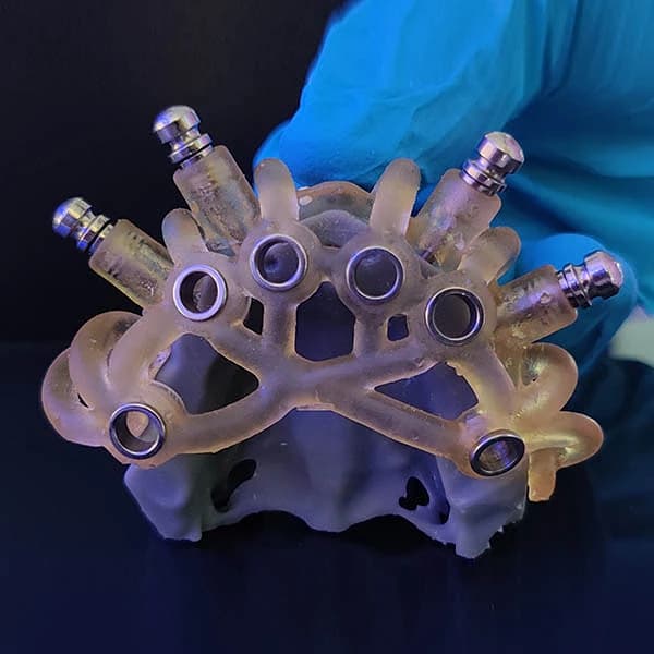 3D-printed surgical guide with metal sleeves seated on an anatomical model.