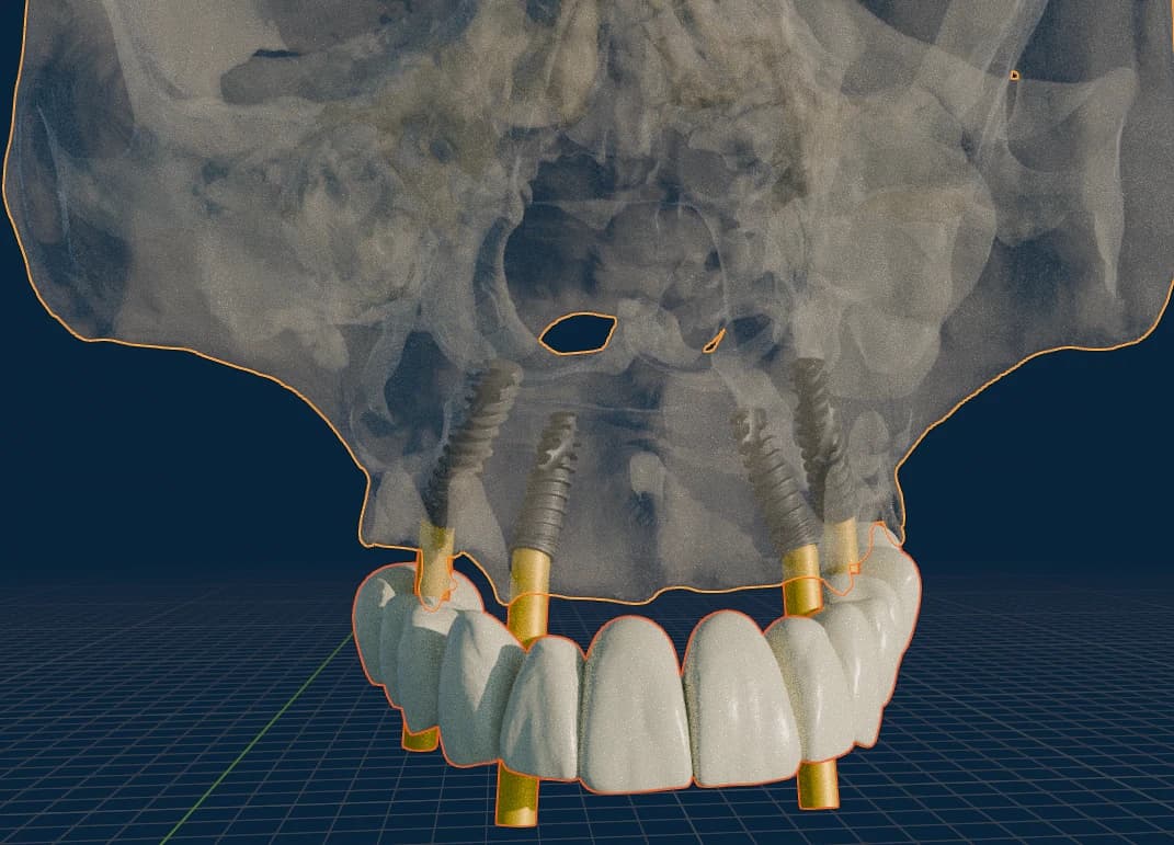 3D implant plan showing guided implant positions against a prosthetic setup.