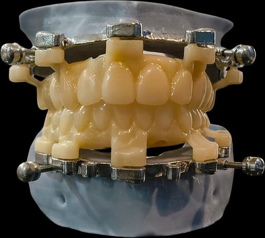 Full-arch implant prosthesis in occlusion on an articulated model.