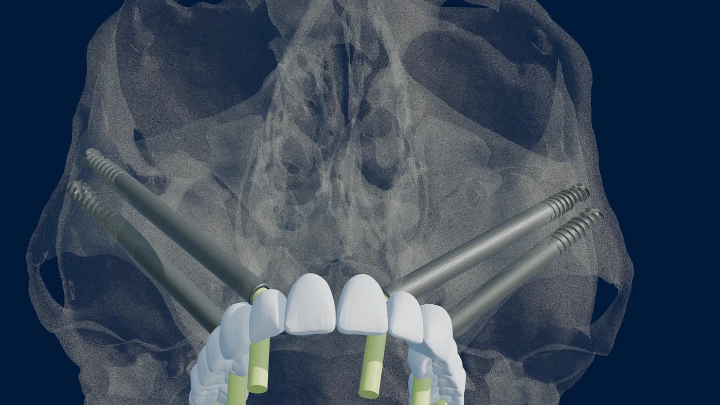 Zygomatic implant plan: four zygomatic implants and multi-unit abutments supporting a full-arch prosthesis over translucent skull anatomy.