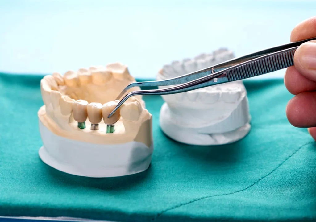 Guided Implant Surgery
