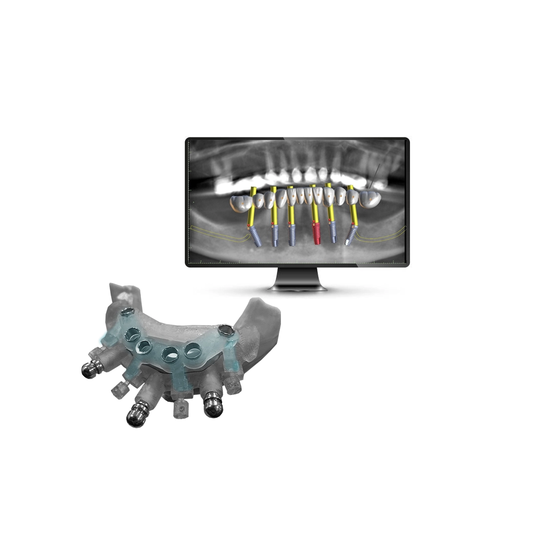 Guided Implant Surgery