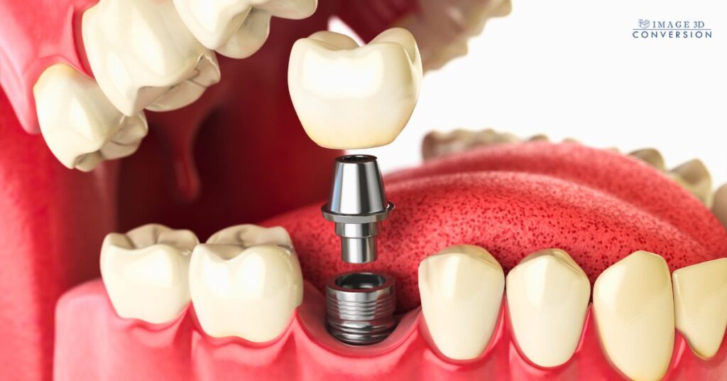 zygoma implant