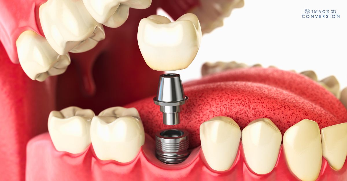 zygoma implant