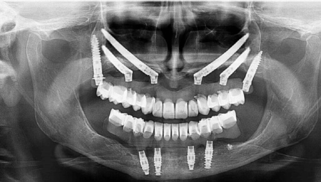 Why Zygoma Implants Are Essential for Successful Full Arch Rehabilitation