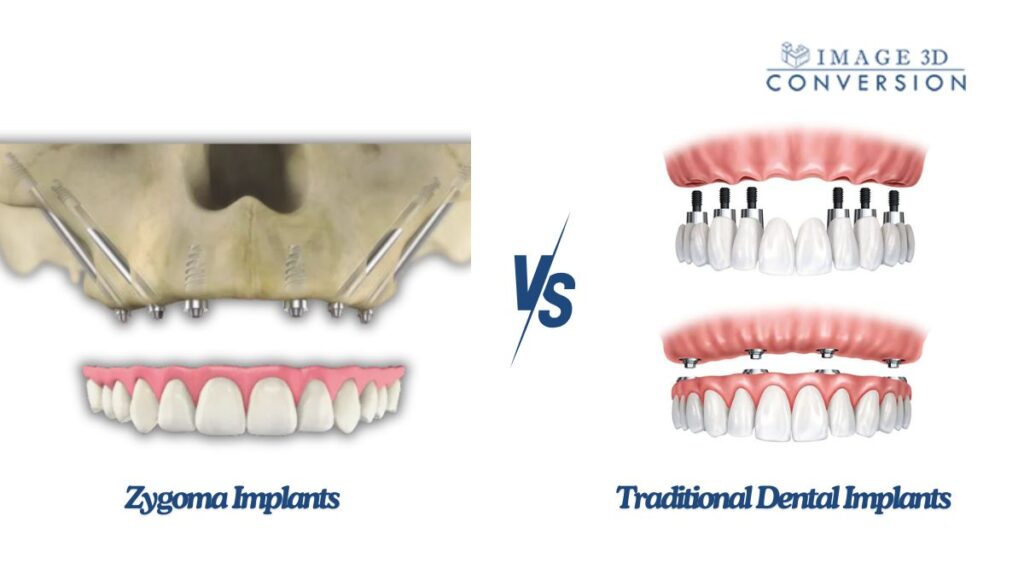 Zygoma-Implants-vs.-Traditional-Dental-Implants-Everything-You-Need-to-Know