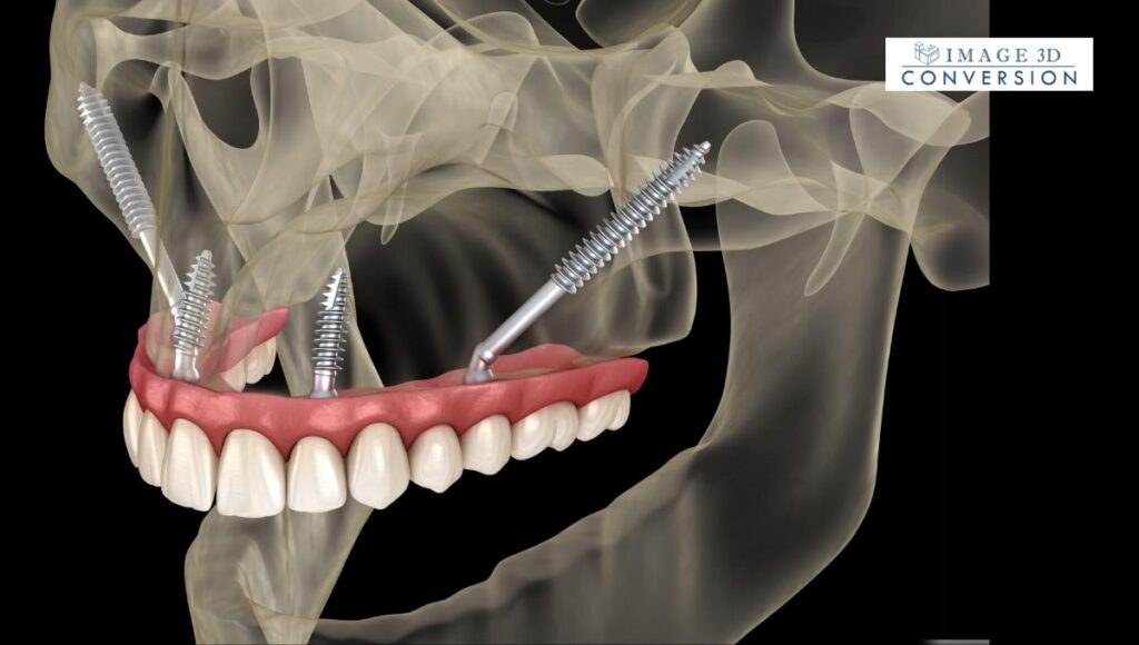 How-Bone-Grafting-Supports-the-Success-of-Zygoma-Implants