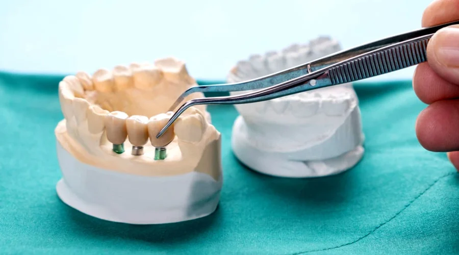 Guided Implant Surgery