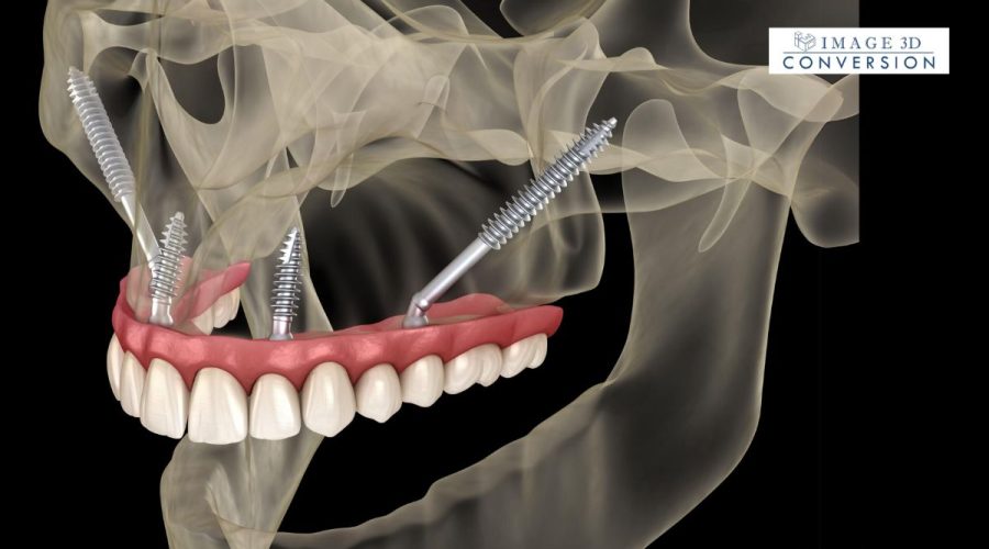 How-Bone-Grafting-Supports-the-Success-of-Zygoma-Implants