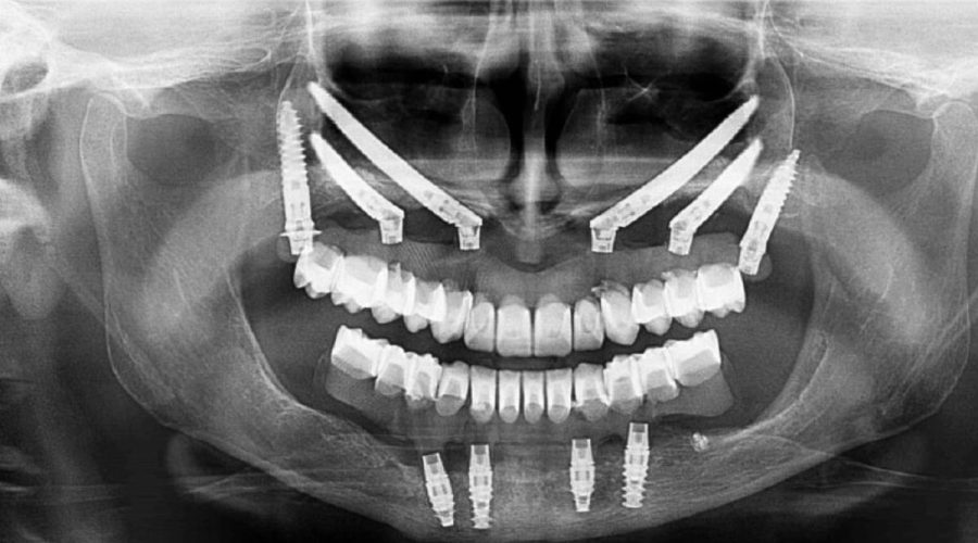 Why Zygoma Implants Are Essential for Successful Full Arch Rehabilitation