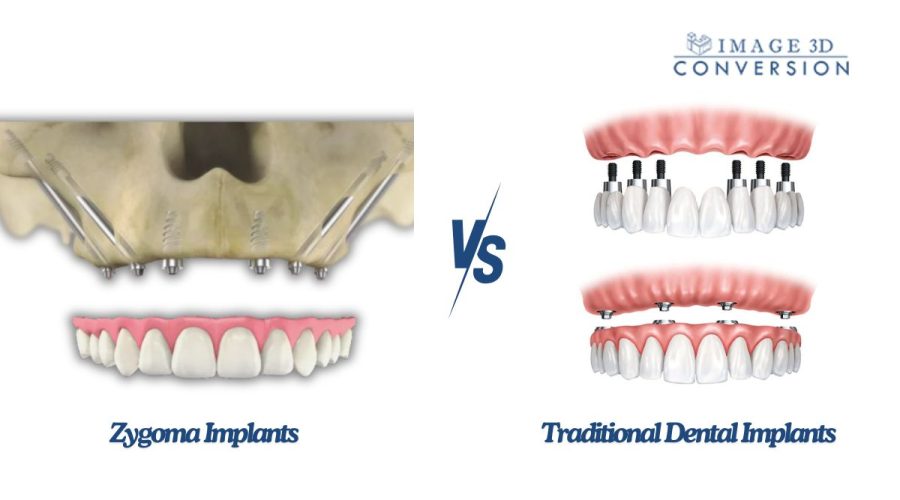 Zygoma-Implants-vs.-Traditional-Dental-Implants-Everything-You-Need-to-Know