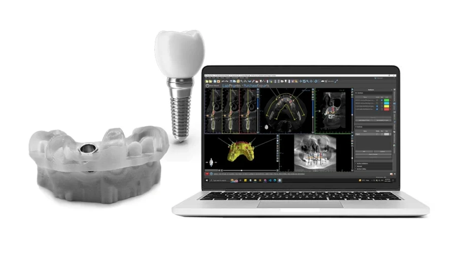 adv-guided-implant