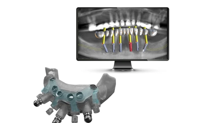 Guided Implant Surgery