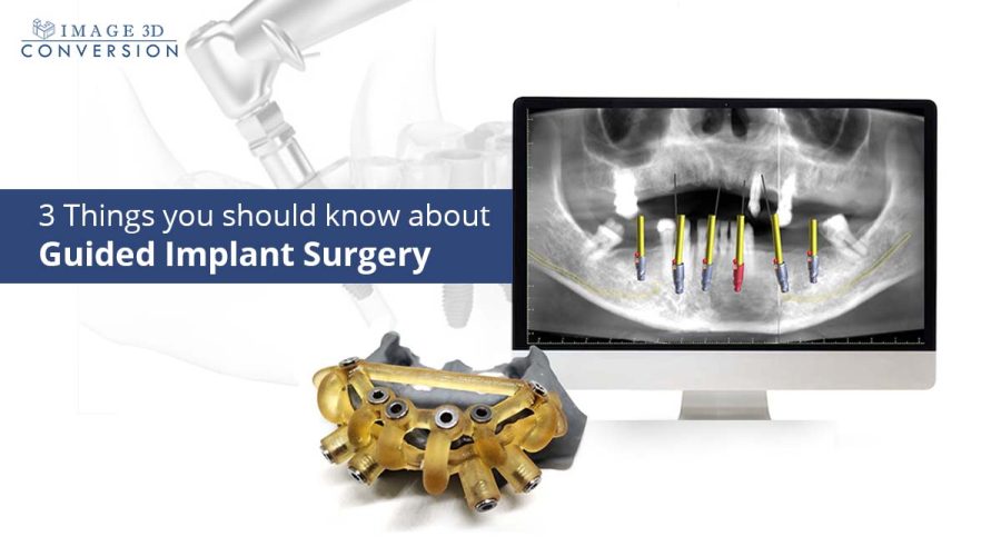 guided-implant-surgery