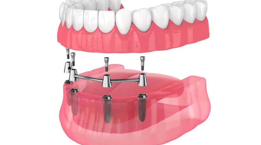 revolutionizing-implant-dentistry