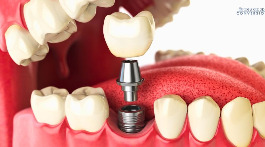 zygoma implant