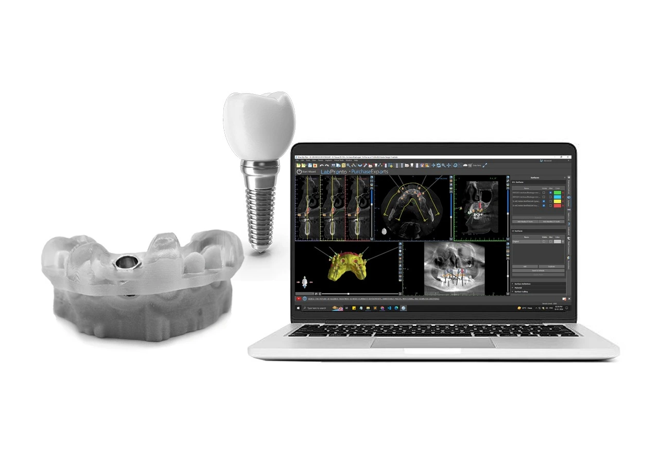 advantages-of-guided-implant-dentistry