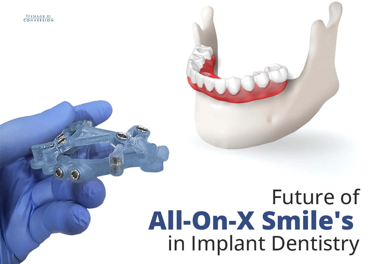 all-on-x-dental-implants