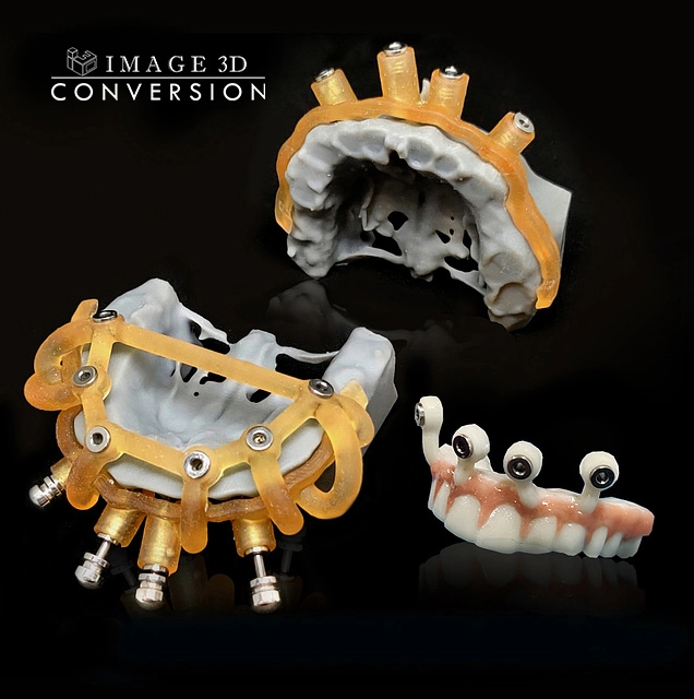 Dental Implant Surgical Guide with Confidence
