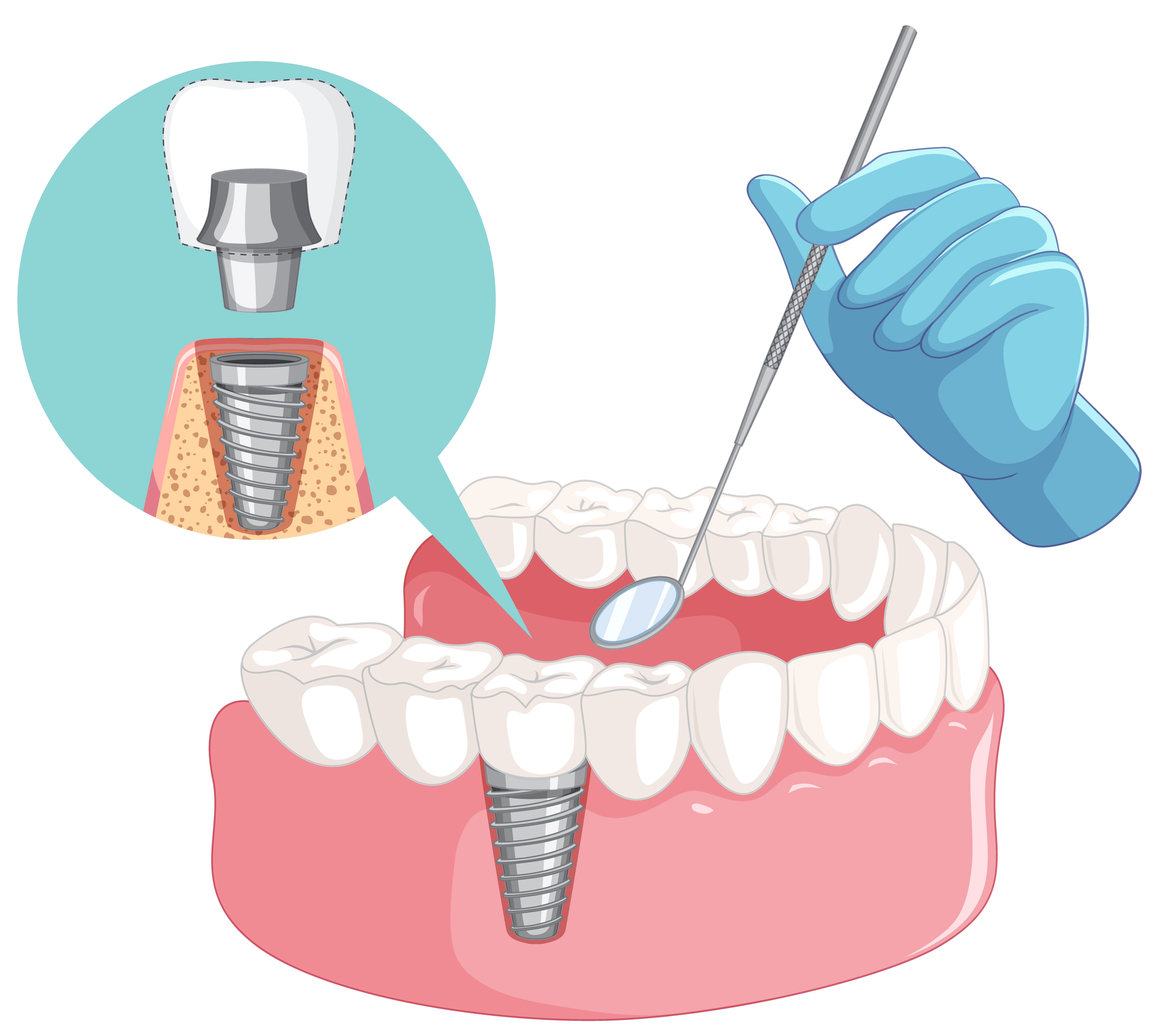 dental-implant-outcomes-the-impact-of-accurate-3d-printing-technology