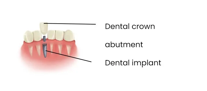 revolutionitizing-dental-implantology