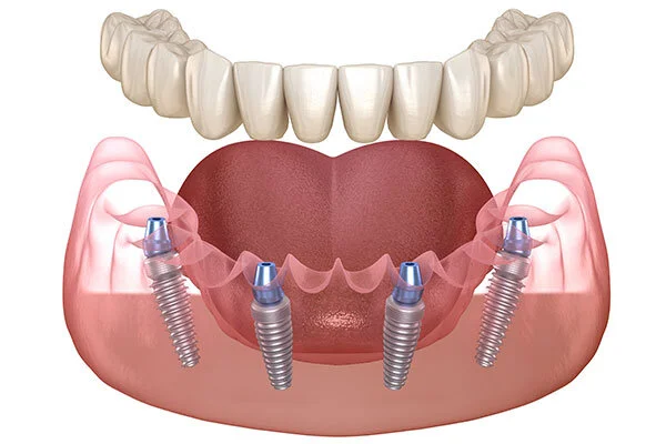 revolutionizing-implant-dentistry
